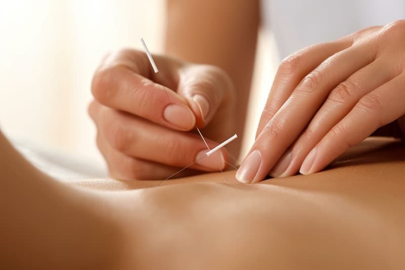 Acupuncteur plaçant des aiguilles